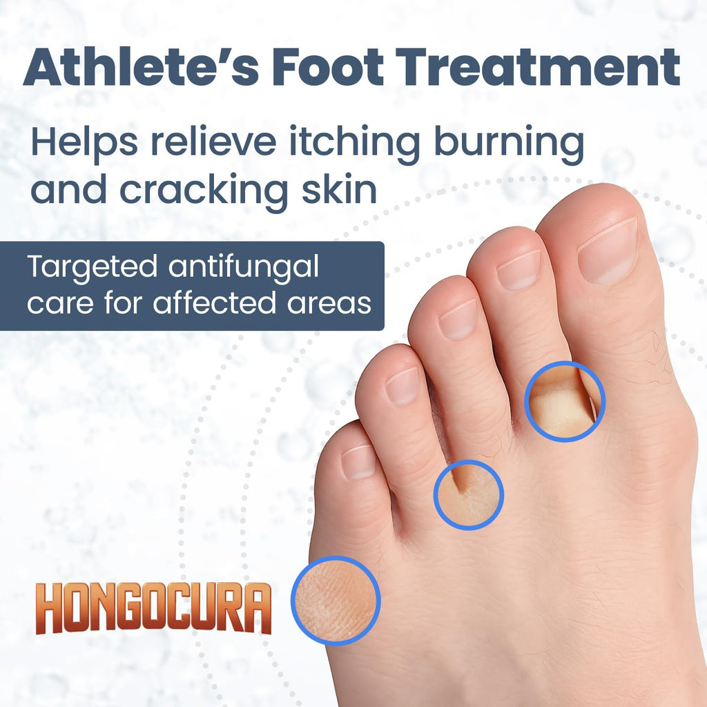 HONGOCURA - Antifungal Cream for Athlete’s Foot | 20 gm | 1-Pack