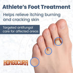 HONGOCURA - Antifungal Cream for Athlete’s Foot | 20 gm | 1-Pack