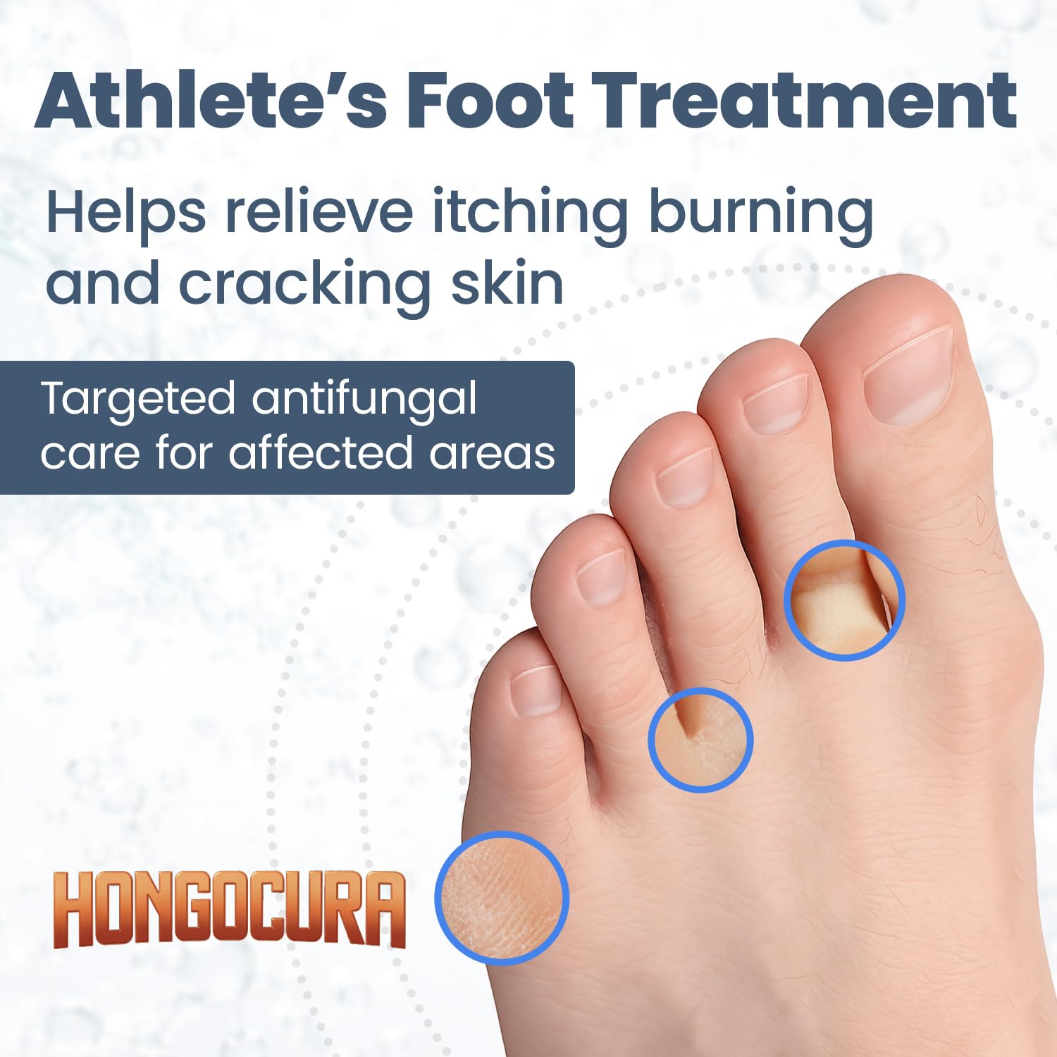 HONGOCURA - Antifungal Cream for Athlete’s Foot | 20 gm | 1-Pack